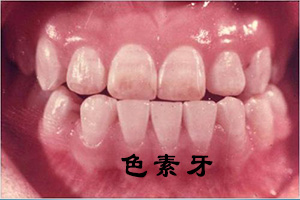 氟斑色牙要怎么进行治疗？