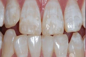 氟斑色牙的表现症状有哪些？
