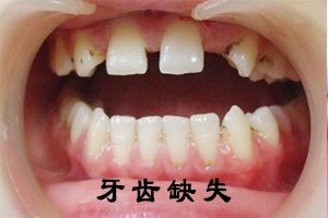 牙齿松动是什么原因？