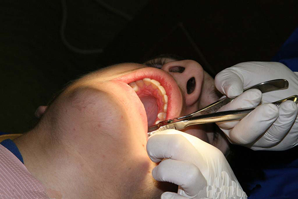痛苦小拔牙方法有哪些?