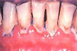 牙齿疾病的发病症状及特征？