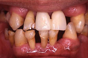 牙周炎能导致哪些问题？