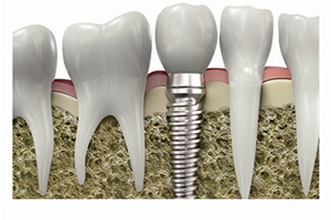 种植牙手术的选择细则是哪些