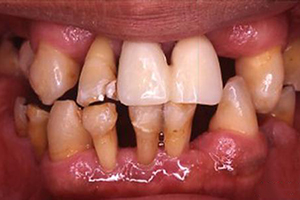 <b>牙周病该如何自我检测？</b>