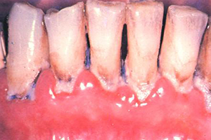 口臭是导致牙齿疾病恶化的大原因？