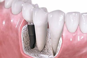 痛苦小种植牙的的技术是怎么样？