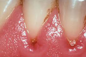 由于牙龈出血导致的口臭该怎么办？