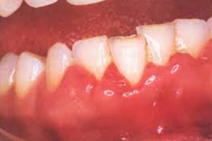 孕妇牙龈出血且伴有口臭是什么原因？