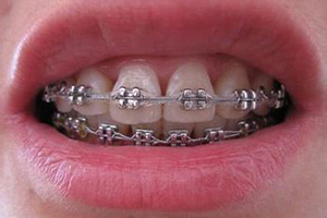 牙齿错位常用的矫正方法是什么？