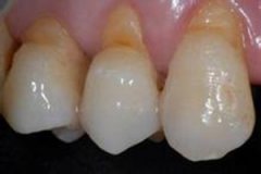 牙齿楔状缺损的原因有哪些？