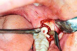 牙种植术的成功标准是什么？