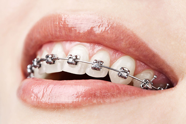 你知道牙齿矫正的详细步骤吗？