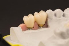 种植牙究竟是什么？
