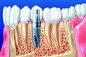 合肥人工种植牙有哪些优点？