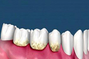 引起牙齿疾病的局部因素有哪些？