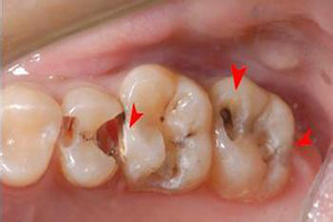 补牙的牙齿能使用多久呢？