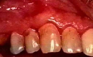 牙齿出血有什么危害呢？