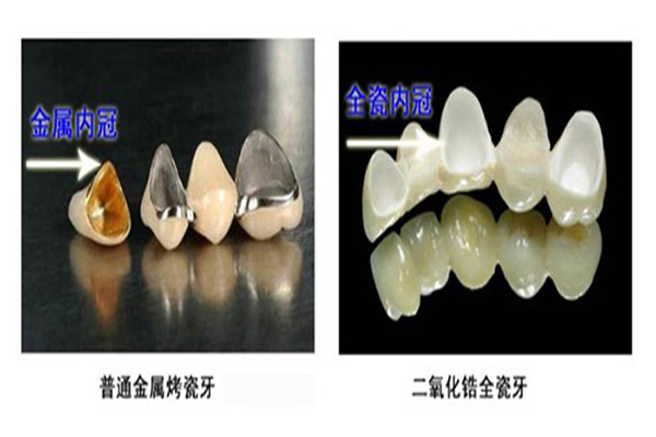 合肥的全瓷牙的优点有哪些？