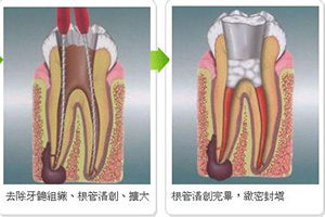 合肥包河区补牙前期口腔护理？