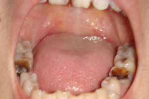 虫牙痛怎么快速止痛？