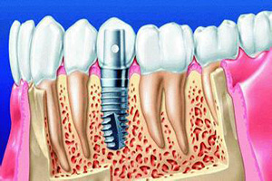 合肥口腔种植牙？