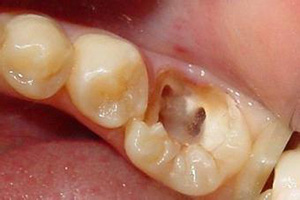 <b>医生解析蛀牙牙疼怎么办？</b>