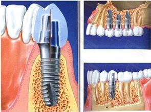 合肥补牙修复的材料有哪些?