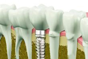 合肥前牙缺失怎么修复？