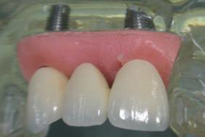 种植牙的危害有哪些呢？
