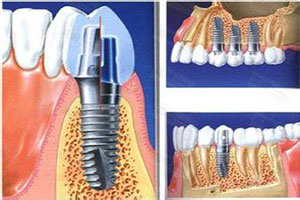 牙齿缺失做种植牙的优点
