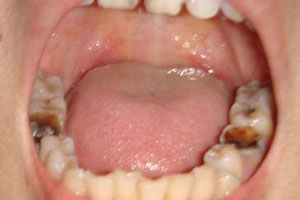 <b>合肥儿童蛀牙牙痛怎么办？</b>
