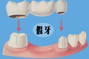 镶牙有哪些必要性？