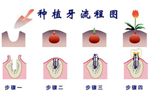 种植牙的注意事项