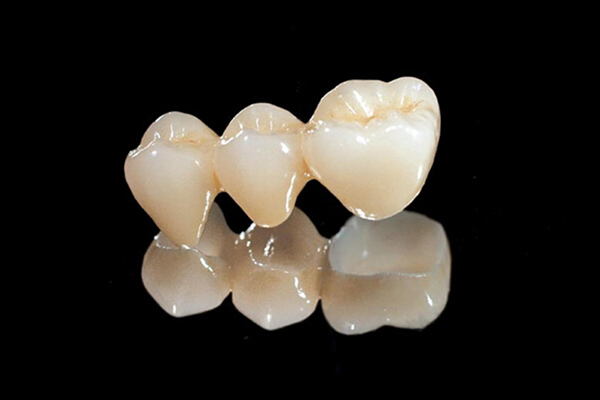 牙冠修复的种类有哪些