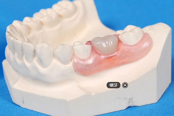 镶牙的材料如何选择