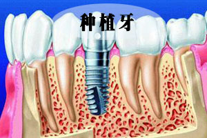合肥种植牙多少钱？