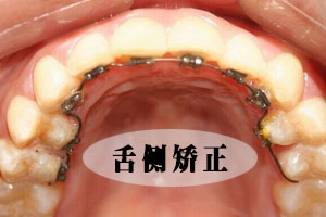 牙齿矫正过程中的注意事项？