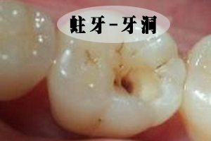 <b>蛀牙形成的原因是什么？</b>
