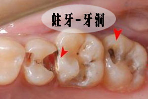 蛀了牙的危害是什么呢?