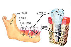 种植牙的过程是什么？