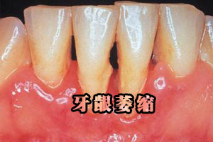 牙龈肿痛怎么快速消肿？