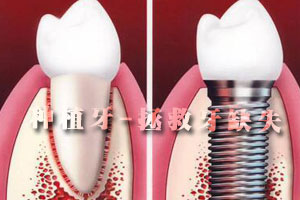牙种植术并发症及其处理？