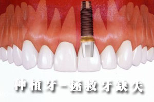 牙种植术注意事项有哪些？