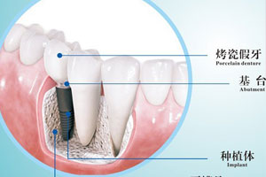 种植牙是缺牙修复适合选择？