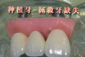 四大种植牙系统-固定义齿？