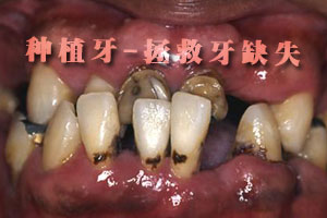 牙体种植之牙周检查？