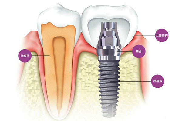 牙体种植的适应征有什么？