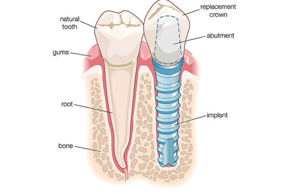牙齿缺失可以种植牙齿吗？