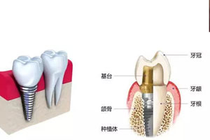 “传统式假牙”与“人工牙根支持式假牙”的区