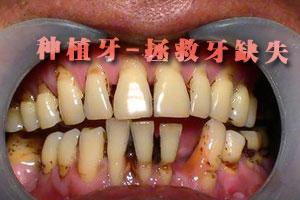 牙齿疏松是怎么回事？